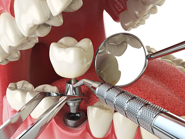 Best Broken or Cracked Tooth Emergency Dentist in Morrice, MI